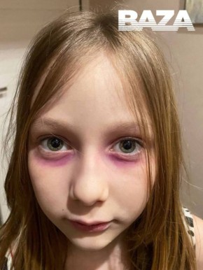 Мать неделю лечила дочь от «редкого аллергического заболевания», из-за которого розовели круги под глазами