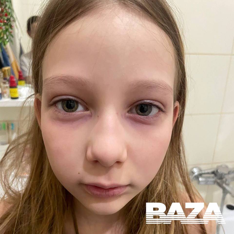 Мать неделю лечила дочь от «редкого аллергического заболевания», из-за которого розовели круги под глазами Мать неделю лечила дочь от «редкого аллергического заболевания», из-за которого розовели круги под глазами